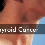 Treatment Options for Different Types of Thyroid Cancer
