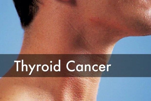 Thyroid Cancer