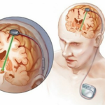 What is the Pre-Surgery Evaluation for DBS Patients?