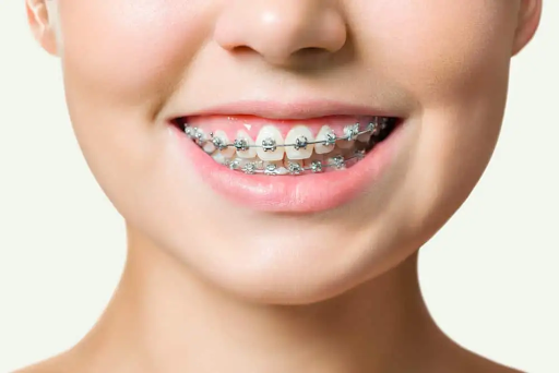 self ligating braces cost in Singapore